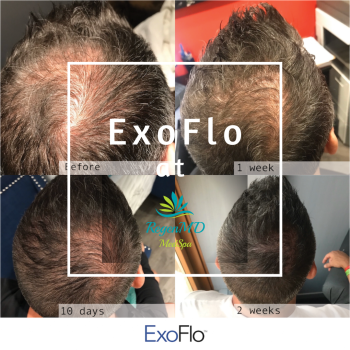 Regenmd Medspa Exoflo Exosome Hair Restoration